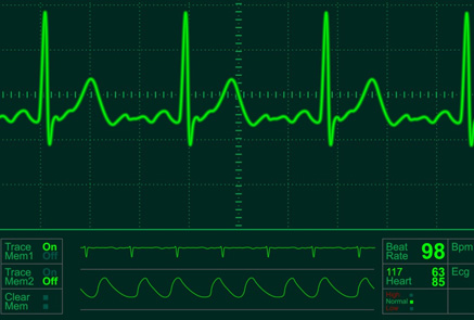 ecg